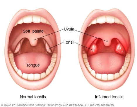 Featured image of post What Are Normal Tonsils Supposed To Look Like