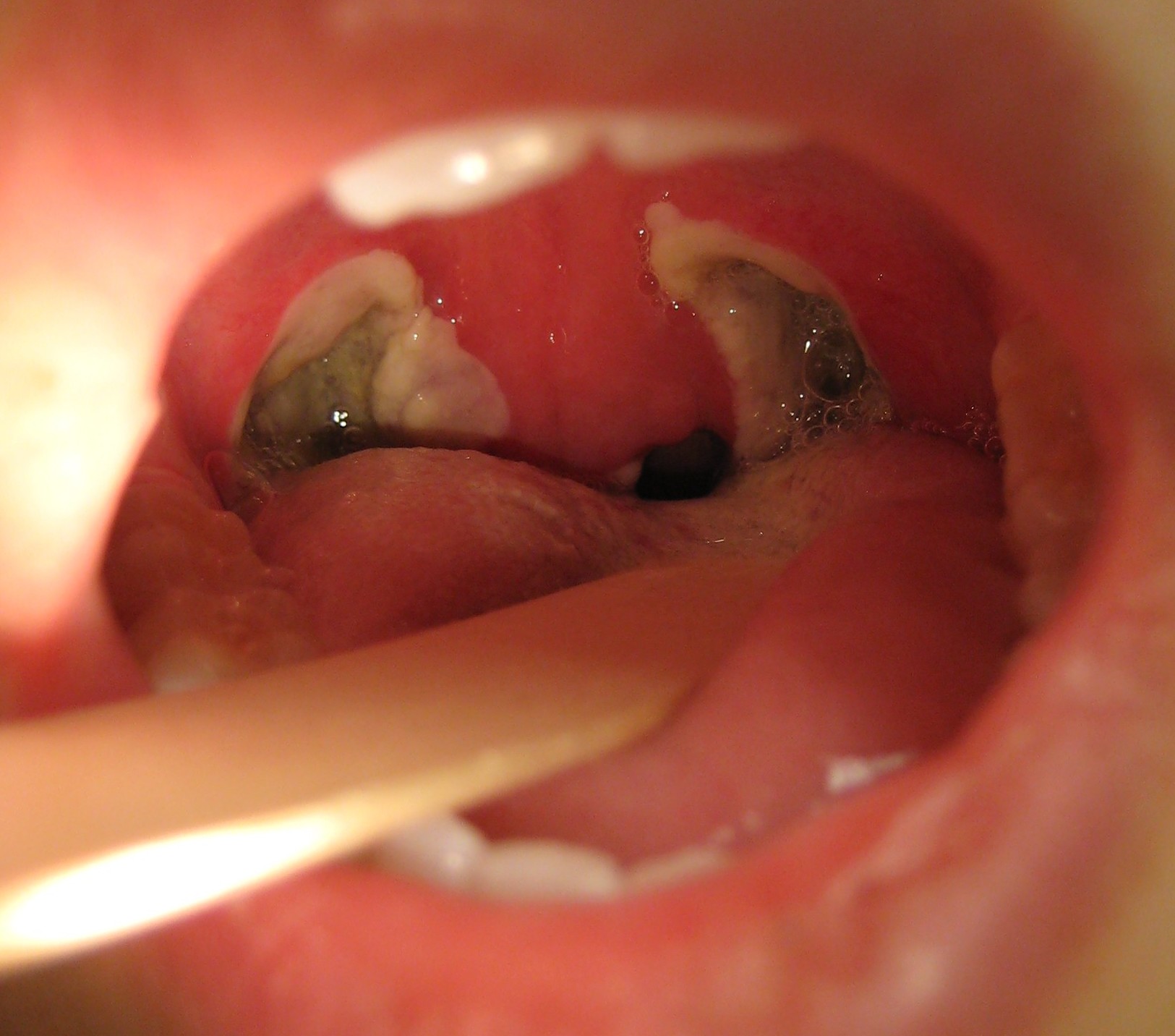 Featured image of post What Are Tonsils Supposed To Look Like After Tonsillectomy