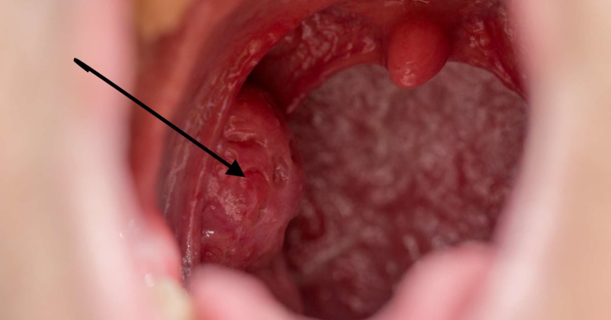 Featured image of post What Are Tonsils Supposed To Look Like