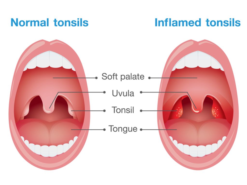 Featured image of post What Are Your Tonsils Supposed To Look Like